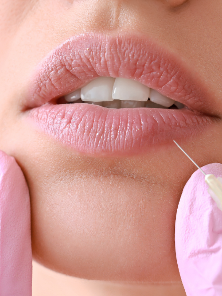 Everything You Need To Know About Lip Fillers
